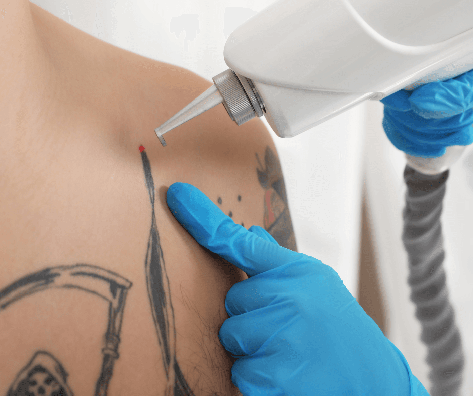 Tattoo Removal Process, Duration, Cost and  Expert Tips