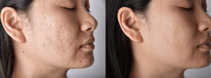 Exploring Acne Scar Treatment Options: A Consumer's Guide