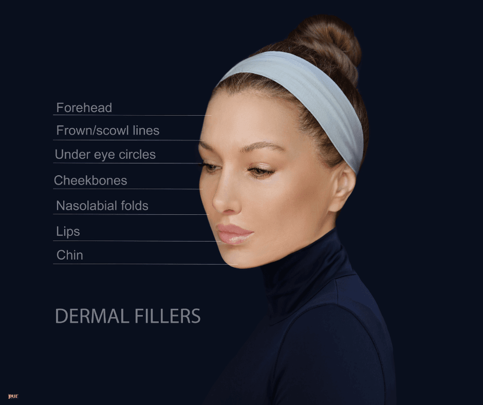 Dermal Fillers for Smile Lines the Ultimate Guide!