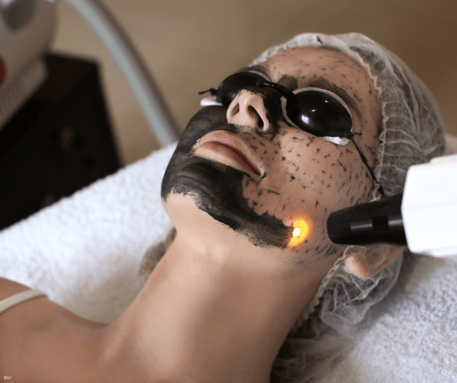 Your Guide to Carbon Laser Peel