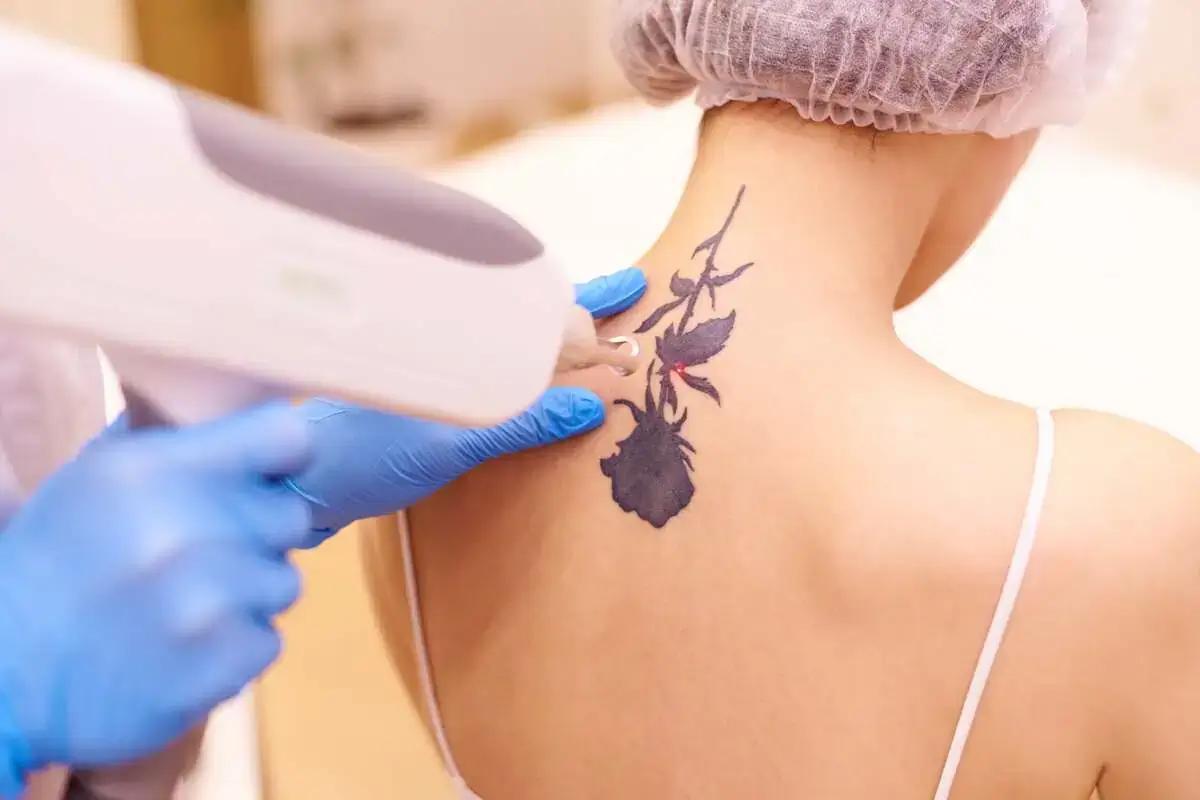 How long does tattoo removal last?