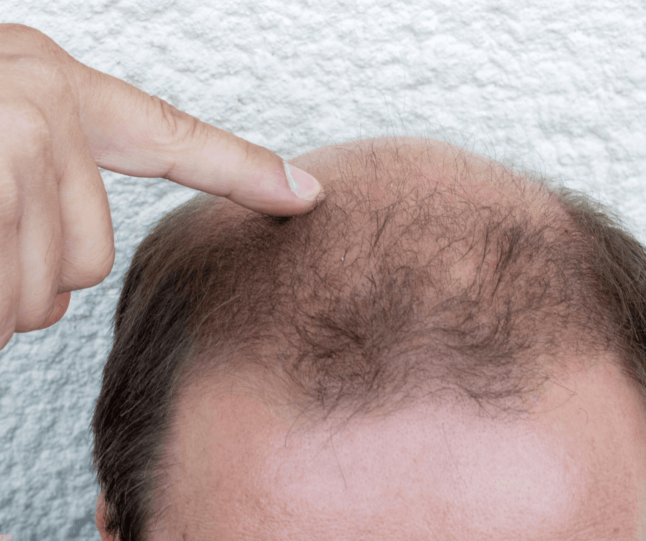 Exosome Treatment for Hair Loss: Protocol and Safety